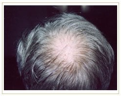 Slider image (3) ProHAIR Transplant Clinic